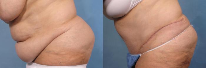 Before & After Tummy Tuck Case 115 View #2 View in Naples and Ft. Myers, FL