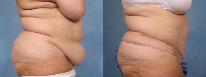 Before & After Tummy Tuck Case 115 View #3 View in Naples and Ft. Myers, FL
