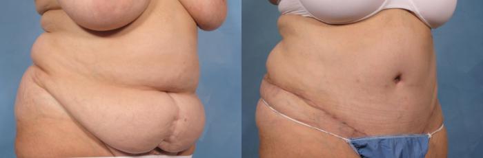 Before & After Tummy Tuck Case 115 View #4 View in Naples and Ft. Myers, FL