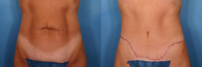 Before & After Tummy Tuck Case 116 View #2 View in Naples and Ft. Myers, FL