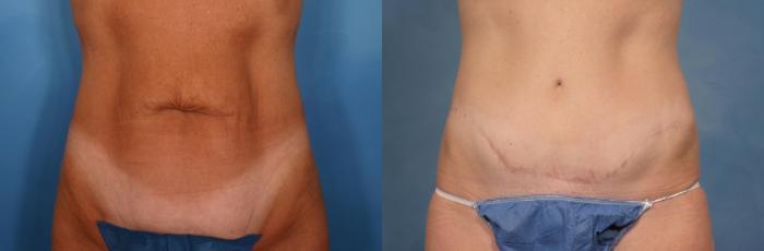 Before & After Tummy Tuck Case 116 View #3 View in Naples and Ft. Myers, FL