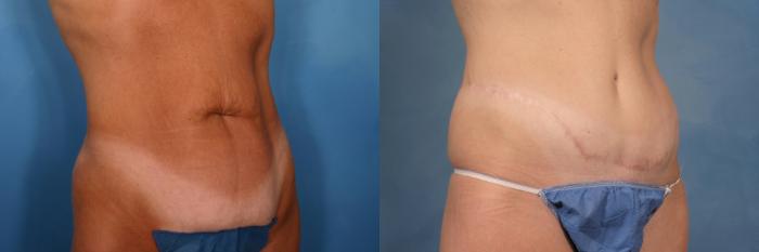Before & After Tummy Tuck Case 116 View #4 View in Naples and Ft. Myers, FL