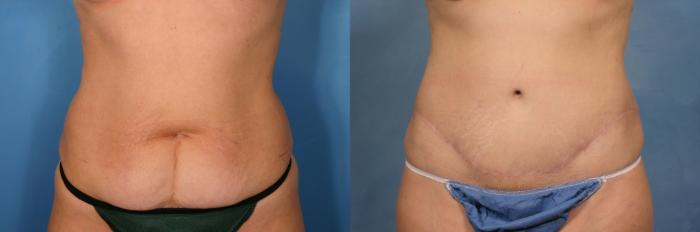 Before & After Tummy Tuck Case 130 View #1 View in Naples and Ft. Myers, FL