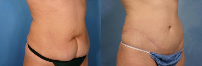 Before & After Tummy Tuck Case 130 View #2 View in Naples and Ft. Myers, FL
