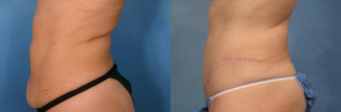 Before & After Tummy Tuck Case 130 View #4 View in Naples and Ft. Myers, FL