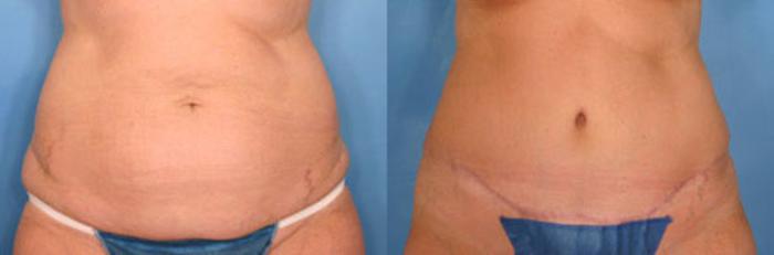 Before & After Tummy Tuck Case 15 View #1 View in Naples and Ft. Myers, FL