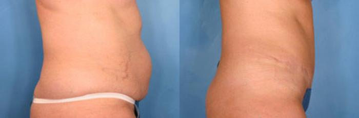 Before & After Tummy Tuck Case 15 View #2 View in Naples and Ft. Myers, FL