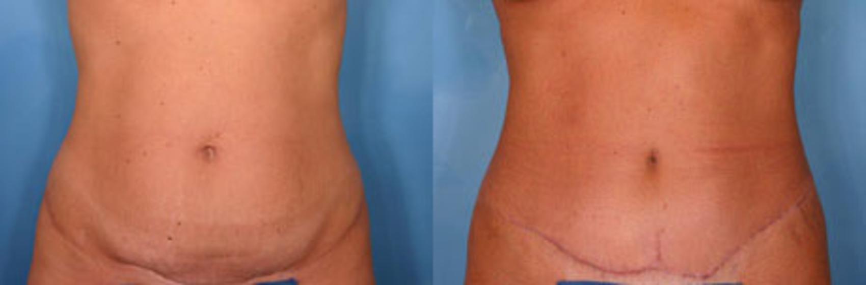 Before & After Tummy Tuck Case 16 View #1 View in Naples and Ft. Myers, FL