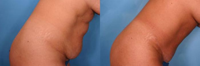 Before & After Tummy Tuck Case 16 View #2 View in Naples and Ft. Myers, FL