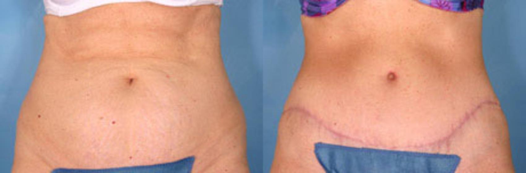 Tummy Tuck Before and After Pictures Case 17