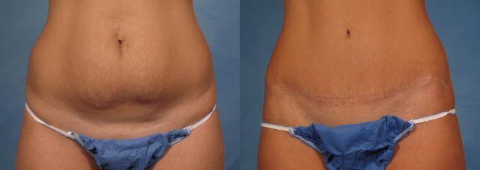 Before & After Tummy Tuck Case 170 View #1 View in Naples and Ft. Myers, FL