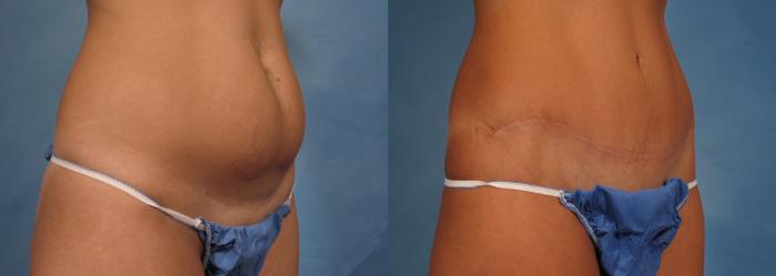 Before & After Tummy Tuck Case 170 View #2 View in Naples and Ft. Myers, FL