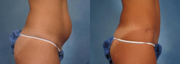Before & After Tummy Tuck Case 170 View #3 View in Naples and Ft. Myers, FL