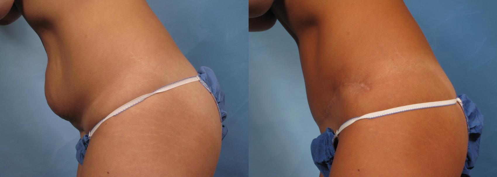 Before & After Tummy Tuck Case 170 View #4 View in Naples and Ft. Myers, FL