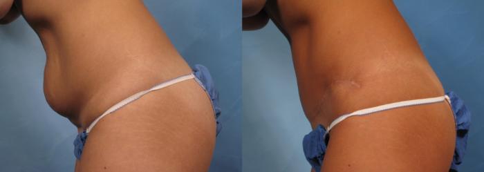 Before & After Tummy Tuck Case 170 View #4 View in Naples and Ft. Myers, FL