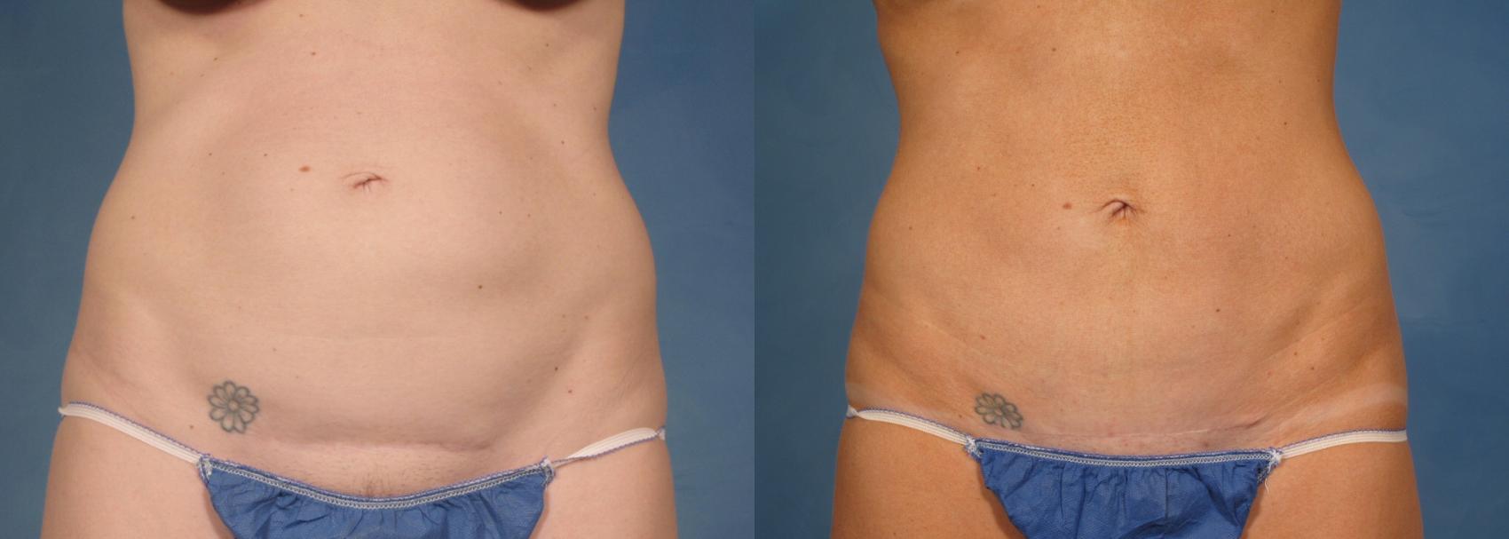 Before & After Tummy Tuck Case 171 View #1 View in Naples and Ft. Myers, FL