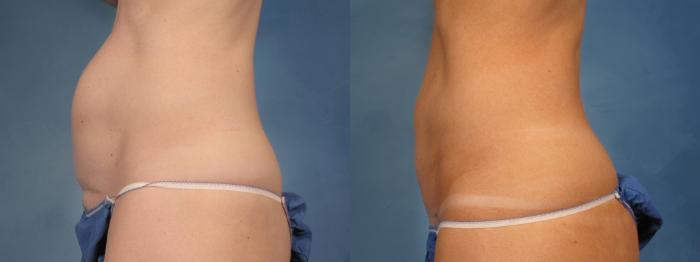 Before & After Tummy Tuck Case 171 View #2 View in Naples and Ft. Myers, FL