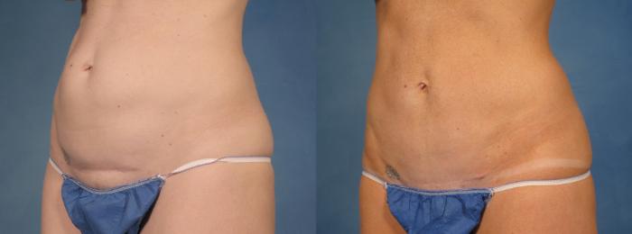 Before & After Tummy Tuck Case 171 View #3 View in Naples and Ft. Myers, FL