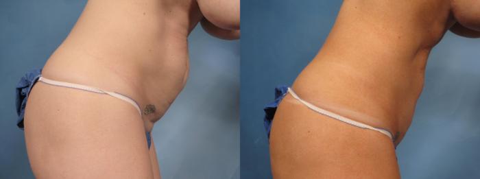 Before & After Tummy Tuck Case 171 View #4 View in Naples and Ft. Myers, FL