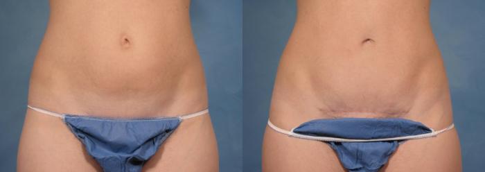Before & After Tummy Tuck Case 172 View #1 View in Naples and Ft. Myers, FL