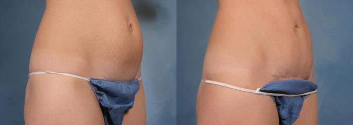 Before & After Tummy Tuck Case 172 View #2 View in Naples and Ft. Myers, FL