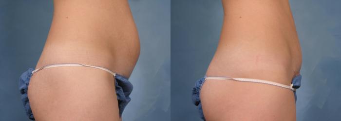 Before & After Tummy Tuck Case 172 View #3 View in Naples and Ft. Myers, FL