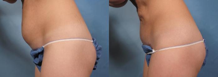 Before & After Tummy Tuck Case 172 View #4 View in Naples and Ft. Myers, FL