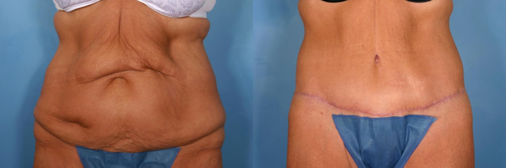 How Long Does it Take to Recover From a Tummy Tuck?