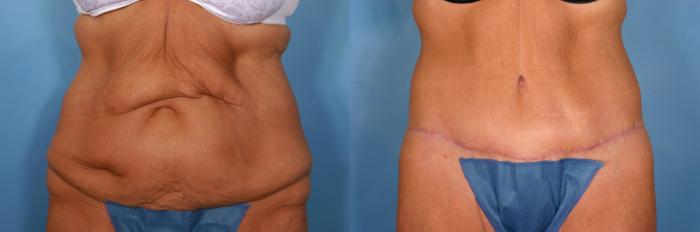 Before & After Tummy Tuck Case 21 View #1 View in Naples and Ft. Myers, FL