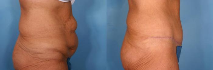 Before & After Tummy Tuck Case 21 View #2 View in Naples and Ft. Myers, FL