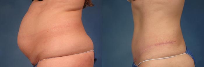 Before & After Tummy Tuck Case 234 View #1 View in Naples and Ft. Myers, FL