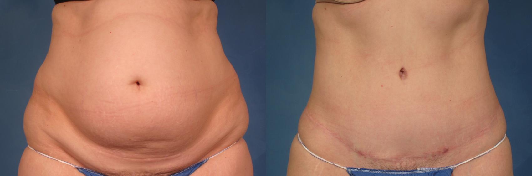 Before & After Tummy Tuck Case 234 View #2 View in Naples and Ft. Myers, FL