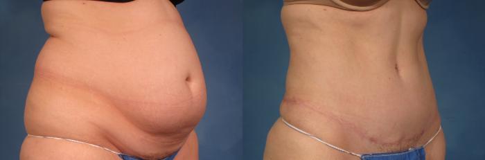 Before & After Tummy Tuck Case 234 View #3 View in Naples and Ft. Myers, FL