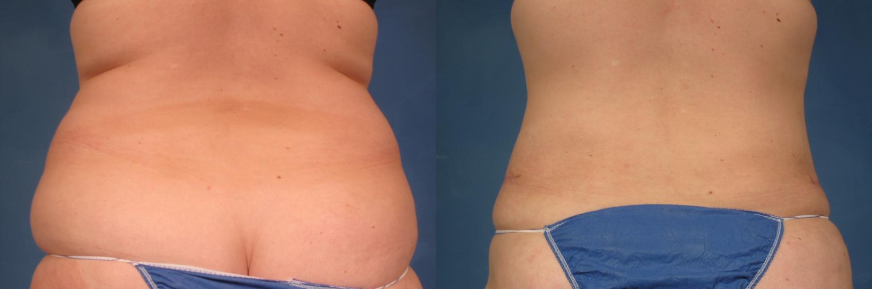 Before & After Tummy Tuck Case 234 View #4 View in Naples, FL