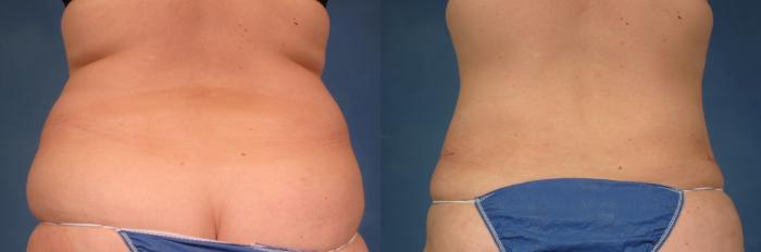 Before & After Tummy Tuck Case 234 View #4 View in Naples and Ft. Myers, FL