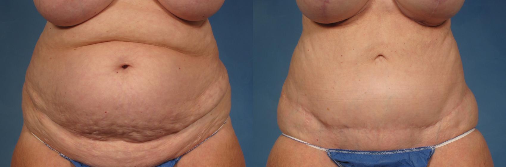 Before & After Tummy Tuck Case 245 View #1 View in Naples, FL