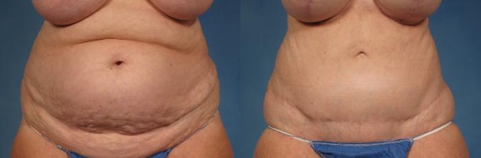 Before & After Tummy Tuck Case 245 View #1 View in Naples and Ft. Myers, FL