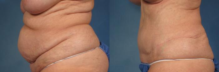 Before & After Tummy Tuck Case 245 View #2 View in Naples and Ft. Myers, FL