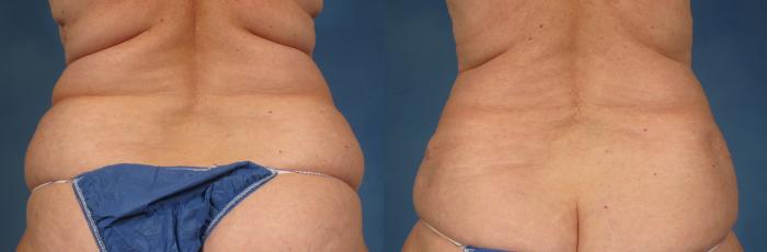 Before & After Tummy Tuck Case 245 View #3 View in Naples and Ft. Myers, FL