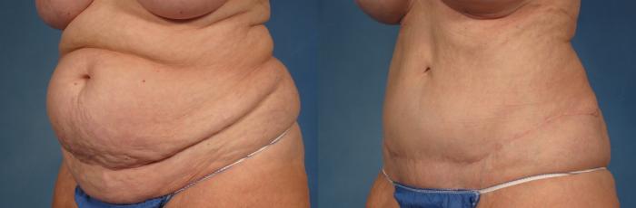 Before & After Tummy Tuck Case 245 View #4 View in Naples and Ft. Myers, FL