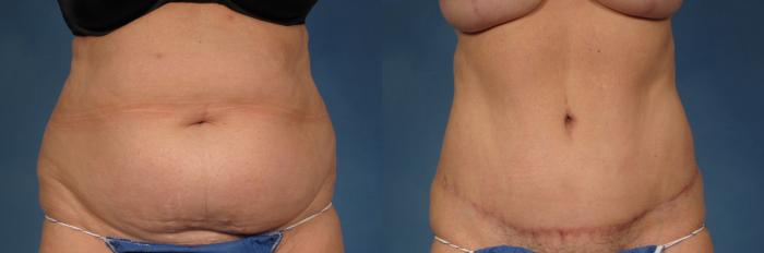 Before & After Tummy Tuck Case 257 View #1 View in Naples and Ft. Myers, FL