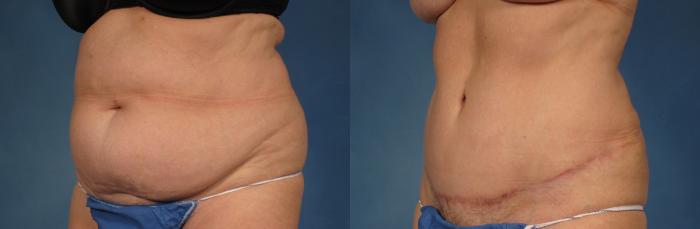 Before & After Tummy Tuck Case 257 View #2 View in Naples and Ft. Myers, FL
