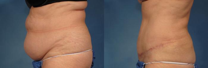 Before & After Tummy Tuck Case 257 View #3 View in Naples and Ft. Myers, FL