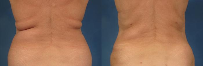 Before & After Tummy Tuck Case 257 View #4 View in Naples and Ft. Myers, FL
