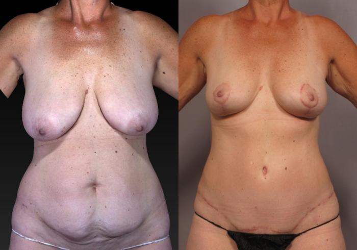 Before & After Tummy Tuck Case 313 View #1 View in Naples and Ft. Myers, FL