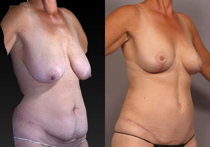 Before & After Tummy Tuck Case 313 View #2 View in Naples and Ft. Myers, FL