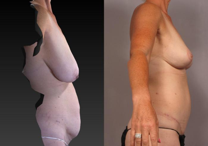 Before & After Tummy Tuck Case 313 View #3 View in Naples and Ft. Myers, FL