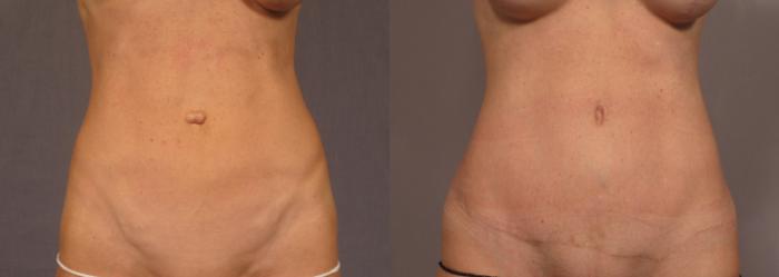 Before & After Tummy Tuck Case 326 View #1 View in Naples and Ft. Myers, FL