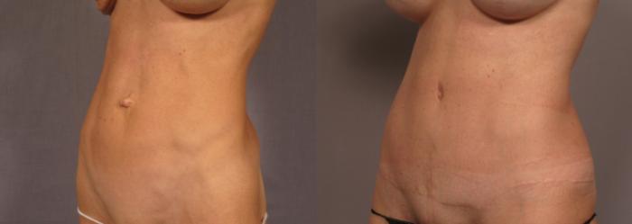 Before & After Tummy Tuck Case 326 View #2 View in Naples and Ft. Myers, FL