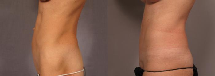 Before & After Tummy Tuck Case 326 View #3 View in Naples and Ft. Myers, FL